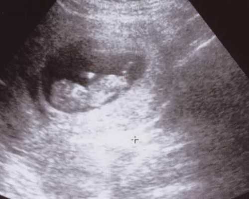 昆明哪里代怀费用最低,什么是试管婴儿？都需要检查染色体吗？_解冻移植和新