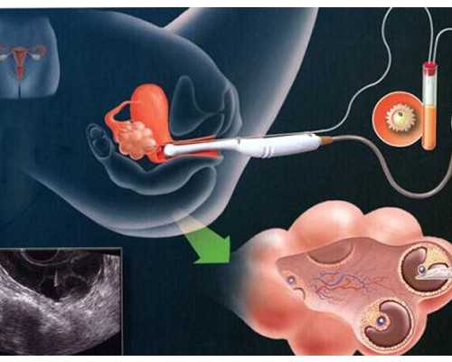 云南供卵的医院|广西民间供卵试管机构哪家好？2023正规民营供卵机构排名榜单